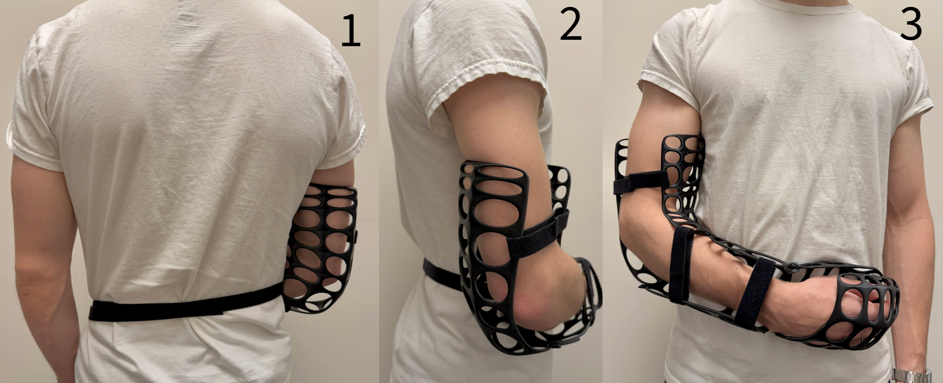 Arm Cast V2 Alternate